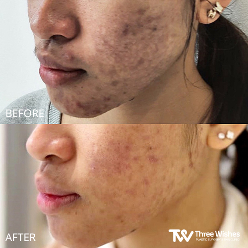 acne treatment before and after in korea