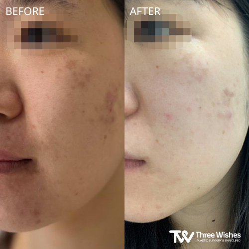 acne treatment before and after in korea