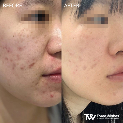 acne treatment before and after in korea