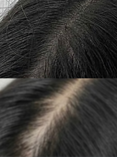 Hairline Scalp Microblading Korea - Hairline & Scalp Microblading in Korea