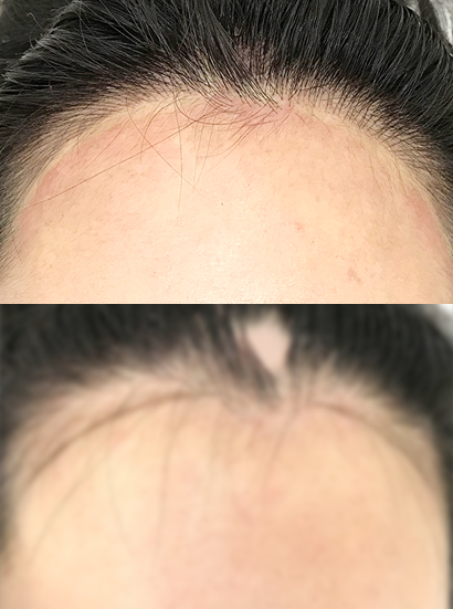 Hairline Scalp Microblading Korea - Hairline & Scalp Microblading in Korea