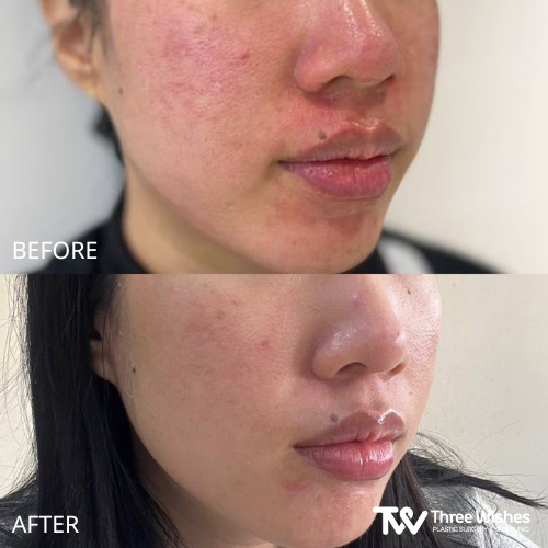 acne treatment before and after in korea